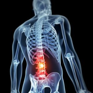 Spinal Stenosis  Diagnosing & Treatment Options: Progressive Spine &  Sports Medicine: Pain Medicine