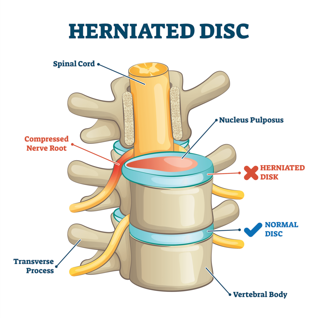 Piriformis syndrome or disc herniation, how do you tell the