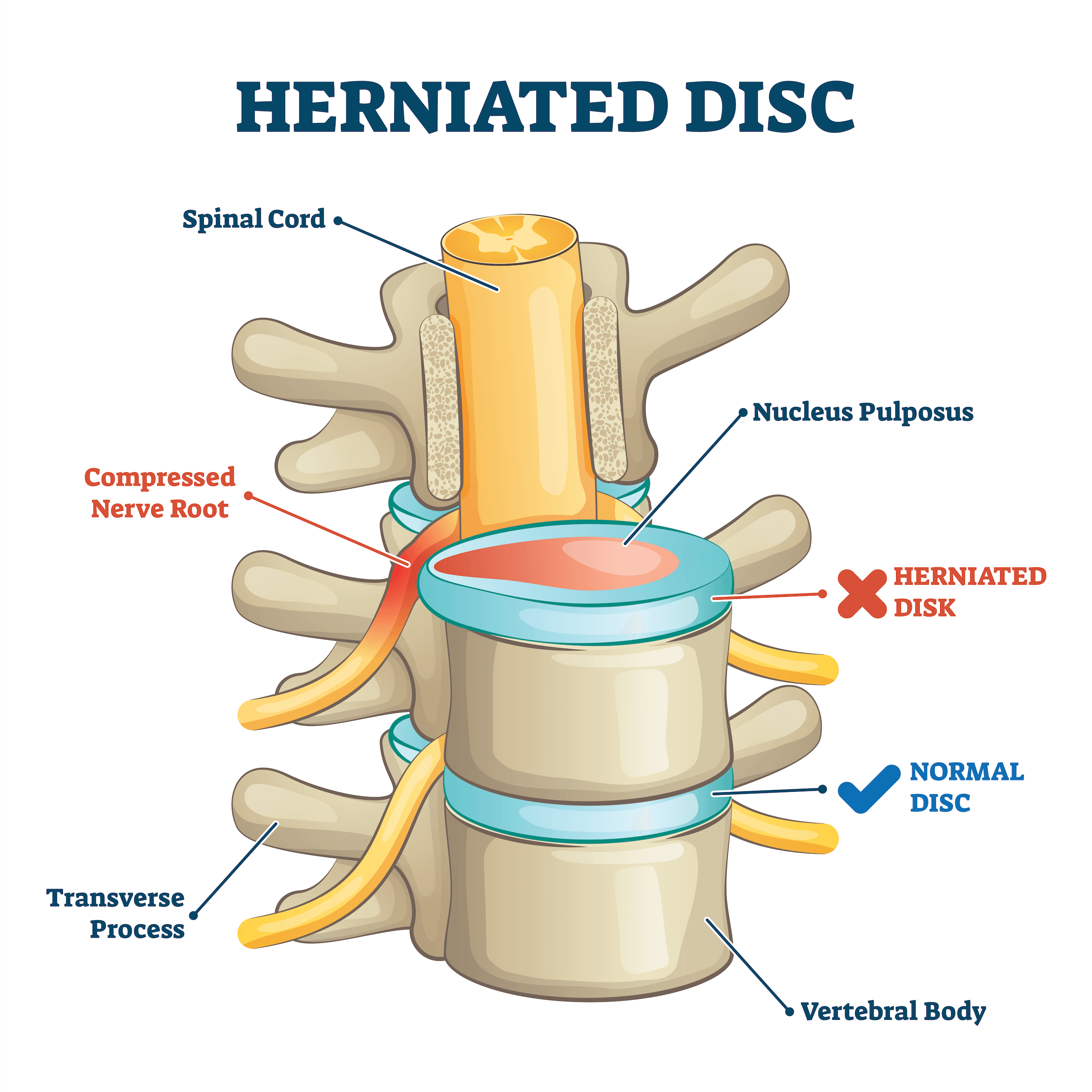 Get Pain Relief from a Herniated Discs