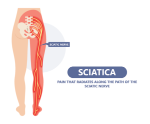sciatic nerve pain relief scottsdale