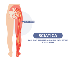 What is Sciatica and What Causes Sciatic Nerve Pain?