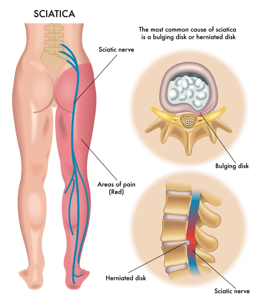 treatment for sciatica caused by herniated disc in Scottsdale.
