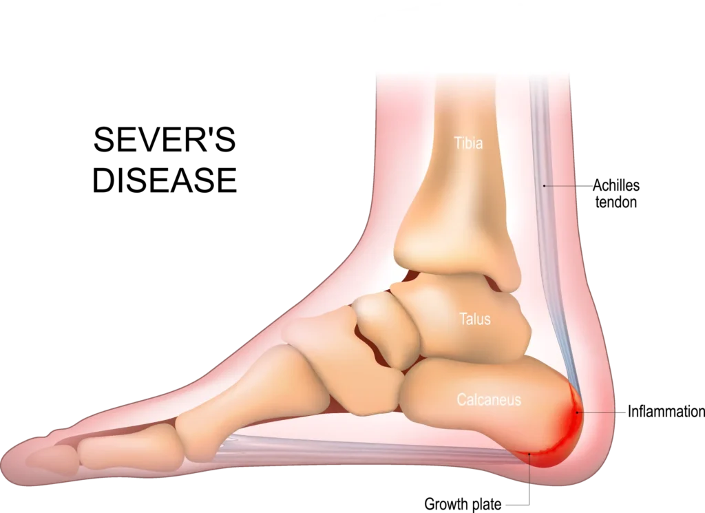 noninvasive sever's disease treatment in Scottsdale.